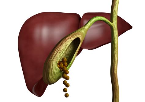 5 facts about gallstones - British Liver Trust
