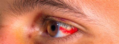 Derrame en el ojo: causas y tratamientos