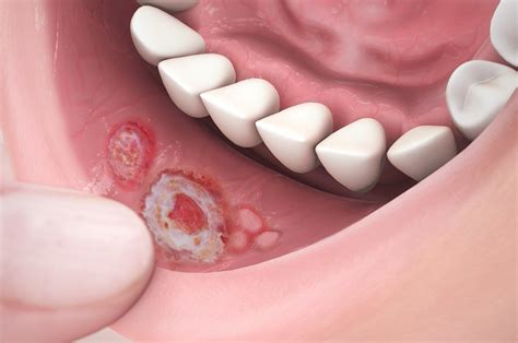 How To Fight Canker Sores - Shopfear0