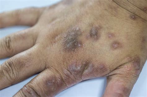 Atopic Dermatitis and Fungal Diseases on the Human Body. Stock Photo ...
