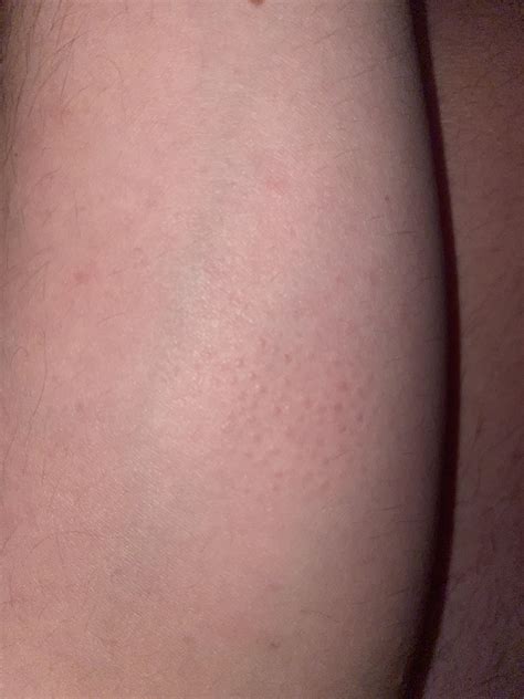 Sudden stomach cramping, bloat, lots of pooping, small patch of