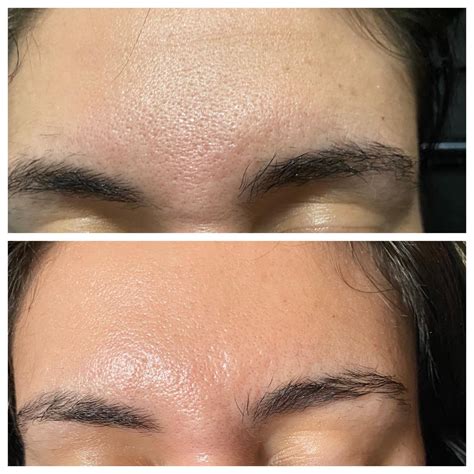 Dr. Pen before & after one session : r/Microneedling