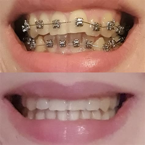 FINALLY! Got my braces off today! : r/braces
