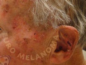 Actinic keratosis - Euromelanoma
