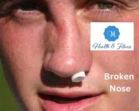 how to know if a nose is broken