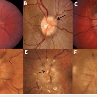 Stages of papilledema on fundoscopic exam (A) Frisén grade zero: normal ...