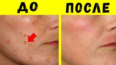Убрать дома веснушки и пигментные пятна быстро! Очень Простые Способы ...