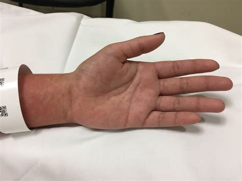 Ebv Rash Amoxicillin