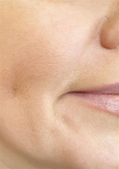 Best Sunken Cheeks Treatment Surrey | The FaceBible Windsor