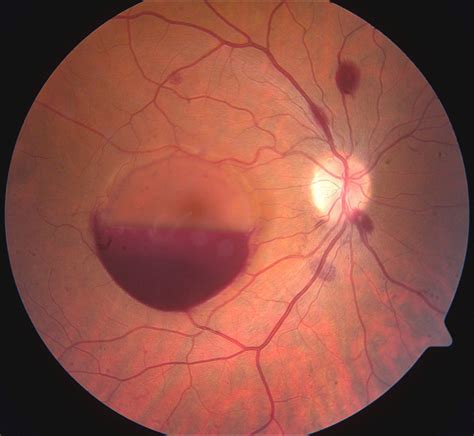 intraretinal hemorrhage