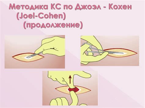 Кесарево сечение в современном акушерстве и родовой травматизм ...