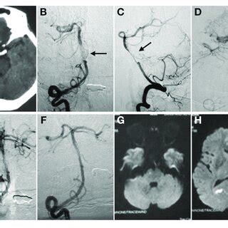 optical coherence tomography  spontaneous basilar artery