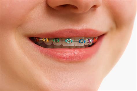 braces treatment ariadni charalambous dds