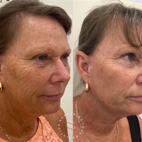 Skin Tightening Treatment Sydney | Laser Skin Tightening | ELC