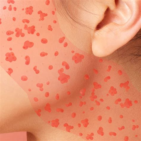How To Get Rid Of Allergic Reaction On Face - Aimsnow7