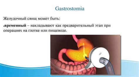 Гастростомия - презентация онлайн
