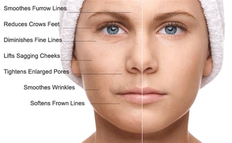MICRONEEDLING | Aglow Aesthetics