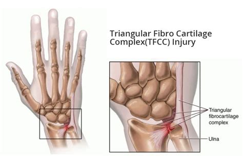 Triangular Fibrocartilage Complex (TFCC) Tear