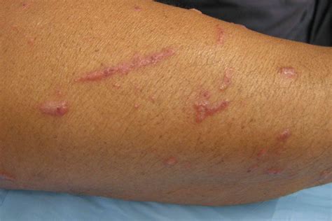 Poison Sumac Rash: Pictures, Causes, Prevention