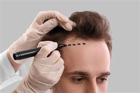 choosing  hair transplant clinic hair doctors