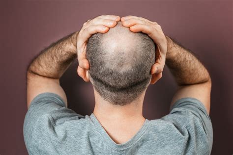 regrow hair  bald spot fast wimpole clinic