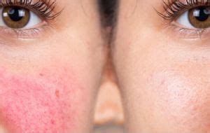 Allergy Treatment in Delhi | Best Allergy Specialist Clinic in Delhi