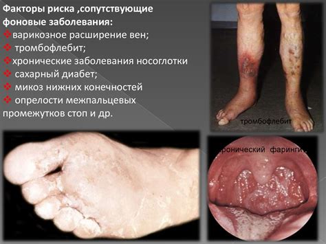 Рожистое воспаление - презентация онлайн