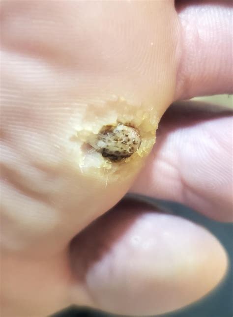Is this a wart, found on the back of my leg? : r/Warts