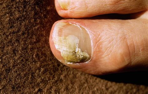 will toenail fungus grow out - Toenail Fungus Treatment | Toenail ...