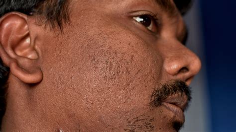 Natural Solutions for Recovering Acne Scars: Heal and Fade Fast ...