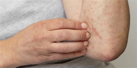 scabies  std essential facts