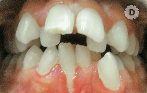 Apiñamiento dental – BLOG DEL ODONTOLOGO