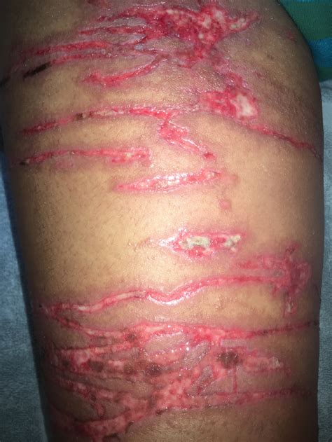 Box Jellyfish Sting Marine Bites And Stings: First Aid And Medical