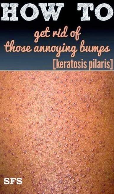 Get Rid Of Bumps Arms - get rid of bumps