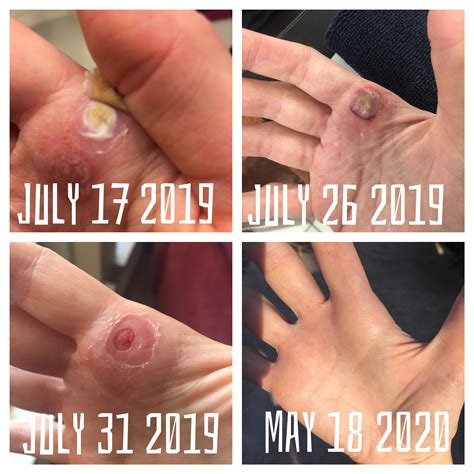 Wart that Dr kept freezing, blistering, and coming back. Was super hard