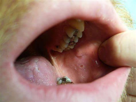 Mouth Sores - Causes, Symptoms, Diagnoses, Treatment, Pictures ...