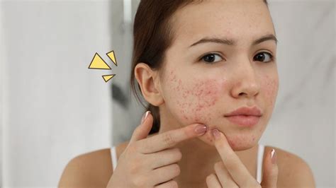 memiliki acne prone skin  perawatan  tepat  mengatasinya