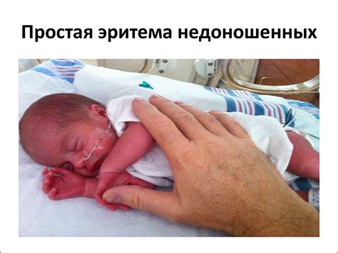 Недоношенные дети - презентация онлайн
