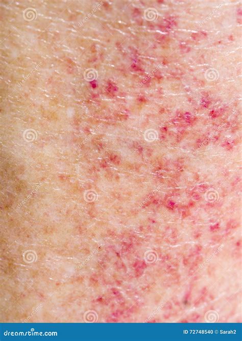 Sun Adverse Reaction, Allergy, Red Rash On Legs. Detail Closeup