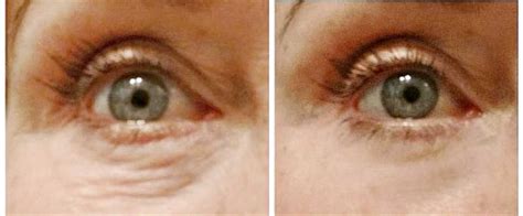 Under Eye Puffiness - My Best & Worst Treatments