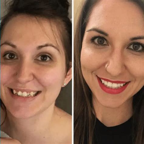 Imagine what Invisalign treatment can do for your smile