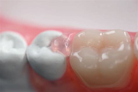 flexible partial denture prodirect dental laboratory