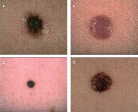 melanoma awareness nodular melanoma   invasive form
