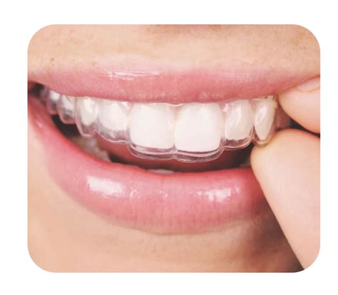 What are Clear Aligners? | Veristic Aligners