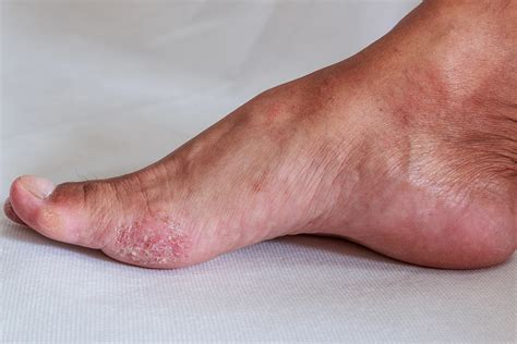 Can You Get Athlete's Foot On Your Ankle Online | emergencydentistry.com
