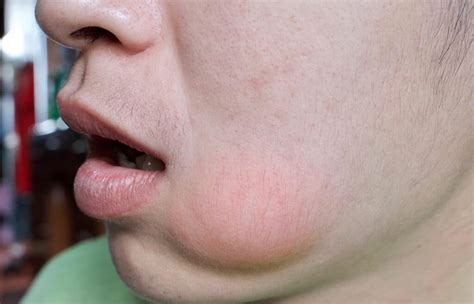 Treatment of Facial Swelling in Thornton CO - Glacier Peak Dentistry