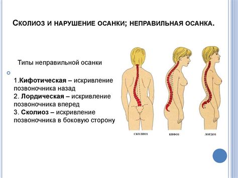 Оздоровительно профилактическая гимнастика при нарушении осанки и ...