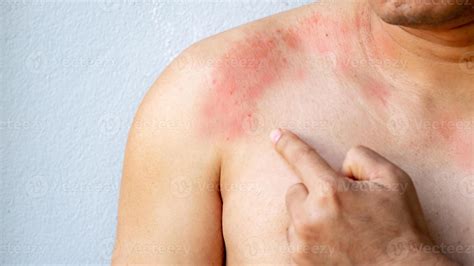 Close up Hand of a man poiting with itchy skin on the body on the chest