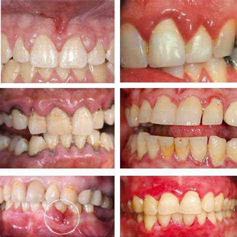 gums swollen   fix swollen gums smzwl