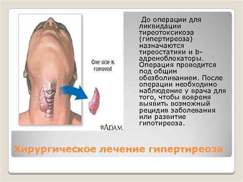 Гипертиреоз ПРЕЗЕНТАЦИЯ подготовлена студентами лечебного факультета 3 ...